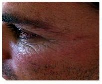 Eye-lior-before
