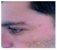 Lior-eye-after