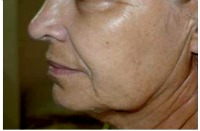 anti-aging-befor