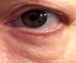 eye-bag-after