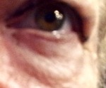eye-bag-before