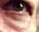 eye-bag-before