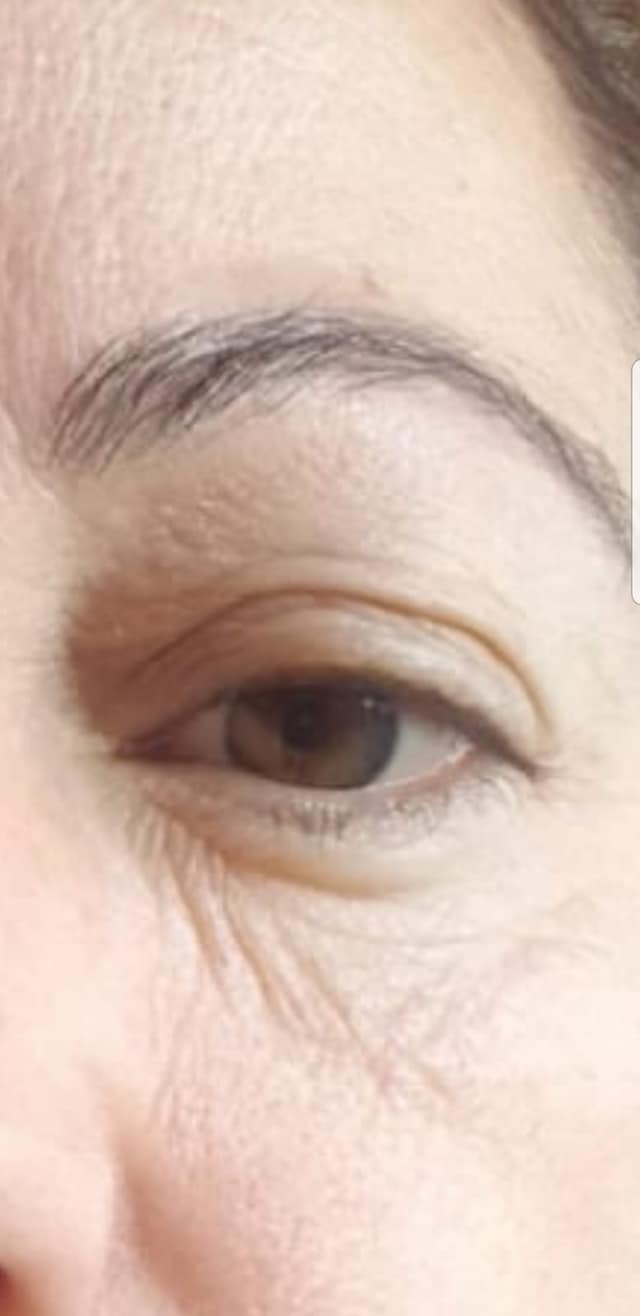 eye-hanit-before
